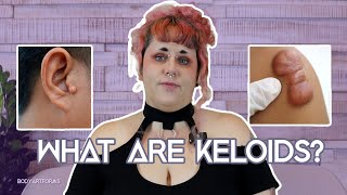 What are keloids [upl. by Airemaj422]