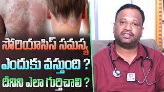 సోరియాసిస్ సమస్య ఎందుకు వస్తుంది   Causes and Precautions for Psoriasis  Psoriasis Treatment [upl. by Ciri]