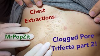 Clogged pores on the chest PART 2 Blackheads steatos and vellus hair cysts Part 1 link below [upl. by Ennylhsa79]