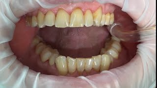 Dentistry  Scale Polish amp Tepe brushing ASMR [upl. by Dash]