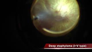 Myopic Foveoschisis with deep staphyloma [upl. by Zil434]