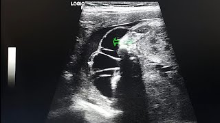 ultrasound case  fetus with hydrocephalus  spina bifida and a meningiocele [upl. by Girardi]