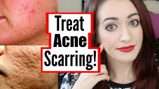 How To Treat Mild Moderate And Severe Acne Scarring DIY At Home amp More [upl. by Yrac184]