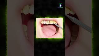 315 Healthy gums What is a plaque  பல் படலம் என்றால் என்ன  DrKarthikeyan  Denta Kings [upl. by Kenison]