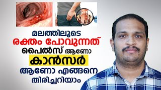 മലത്തിലൂടെ രക്തം പോവുന്നത് പൈൽസ് ആണോ കാൻസർ ആണോ എങ്ങനെ തിരിച്ചറിയാം  Piles or Cancer  Arogyam [upl. by Ayhdiv924]