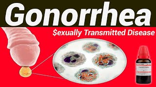 Gonorrhea homeopathic treatment [upl. by Inigo]