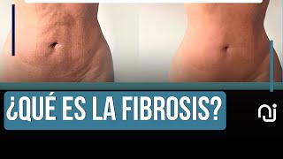 Puntos Claves Sobre la Fibrosis en la Liposucción [upl. by Anaela]