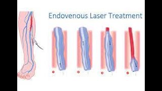 TRATAMIENTO MINIMAMENTE INVASIVO ABLACIÓN ENDOVASCULAR CON LASER [upl. by Nosnorb526]