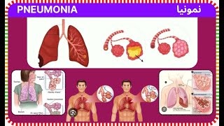 pneumonia  namonia  निमोनिया [upl. by Aisayt]