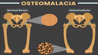 How osteoporosis develops  Bupa Health [upl. by Ojela842]