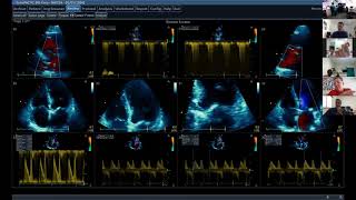 Aortic Stenosis 1 [upl. by Arondel387]