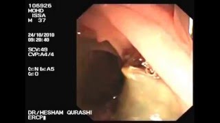 ERCP Removal of live Fasciola hepatica from Common bile duct [upl. by Suiratnod]