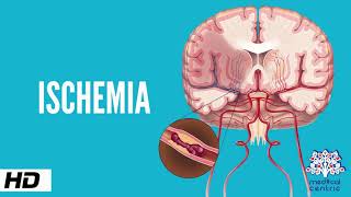 Ischemia Causes Signs and Symptoms Diagnosis and Treatment [upl. by Nitsuj]