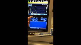 Identifying and Treating AutoPEEP [upl. by Esirtal664]