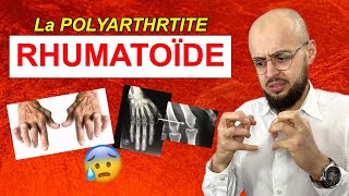 Les symptômes de la POLYARTHRITE RHUMATOÏDE [upl. by Aserat]