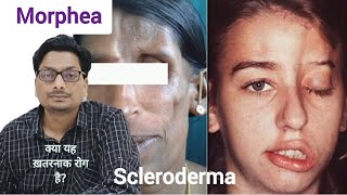 Morphea  Localized Scleroderma क्या यह ख़तरनाक बिमारी है morphea scleroderma systemicsclerosis [upl. by Nilorac875]