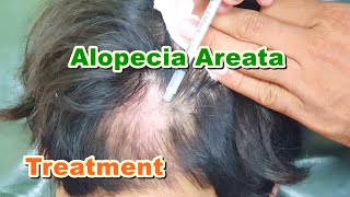 Alopecia Areata Treatment by ILS Intralesional Steroid Injections  Triamcinolone Acetonide [upl. by Leverick948]