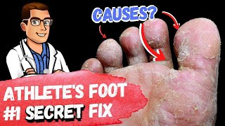 BEST Athletes Foot Fungus Treatments HOME Remedies  3 BIG SECRETS [upl. by Lomasi]