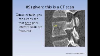 Spondylolysis  Spondylolisthesis Learning Quiz [upl. by Rairb]