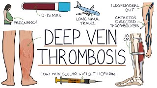 Understanding Deep Vein Thrombosis DVT [upl. by Aridatha]