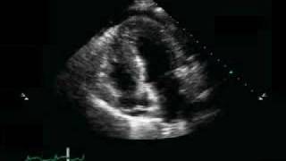 Pericardial Effusion Pulmonary Edema [upl. by Klump]