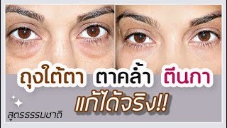 วิธีลดถุงใต้ตา รอยคล้ำใต้ตา ลดริ้วรอยใต้ตา ตีนกาแก้ได้ เห็นผลจริง  Get Rid of Bags Under Eyes Fast [upl. by Erde]