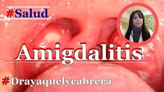 AMIGDALITIS angina Bacterianas ó virales como diferenciarlas😖 → 👩🏽‍⚕️DraYaquely Cabrera 🩺 [upl. by Fretwell]