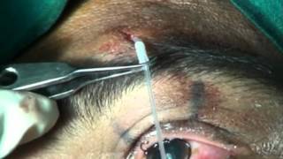 PTOSIS SURGERY VIA SUPRABROW SINGLE STAB INCISIONnew technique frontalis sling Soosan Jacobmpg [upl. by Marquez820]