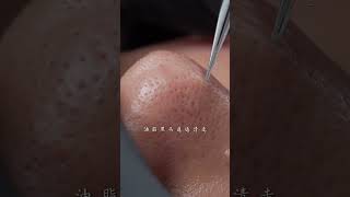 Take good care of your skin during the season change immersiveskincare blackheads asmr facespa [upl. by Puglia]