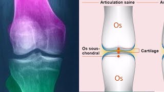 Comment soigner et régénérer le cartilage du genou naturellement [upl. by Nisse641]