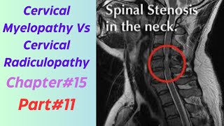 Cervical Myelopathy Vs Cervical Radiculopathy  Part11 Causes  Symptoms  Differences Exercises [upl. by Akcirred]