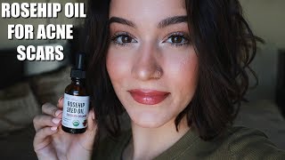 TRYING ROSEHIP OIL FOR A MONTH FOR ACNE SCARS [upl. by Ellah]