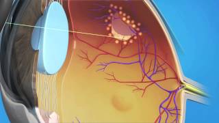 Retinal Tear Surgery [upl. by Athalee]