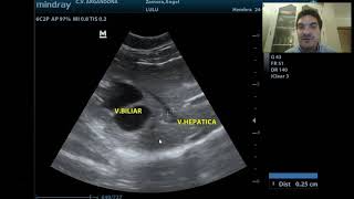 Ecografía abdominal parte 3 [upl. by Notgnilra25]