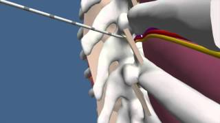 Techniques for Thoracic Paravertebral Block TPVB [upl. by Namyac]