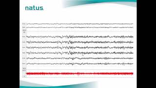 Natus PSG Webinar Case Study Scoring Sleep Stages amp Limb Movements [upl. by Yruy]