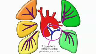 Pathological anatomy course TOF with pulmonary atresia 7 [upl. by Aire]