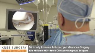 Arthroscopic Knee Surgery  Meniscus Surgery Performed by Dr Millstein [upl. by Llerrej]