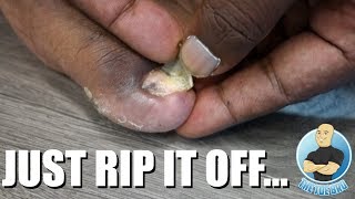 REMOVING A TOENAIL USING MY BARE HANDS [upl. by Asseneg]