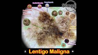 Lentigo Maligna Melanoma [upl. by Ibrik830]