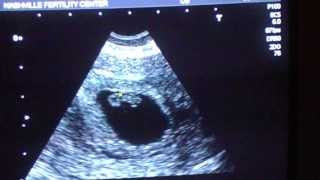 7 Week and 1 Day Ultrasound [upl. by Bamby]