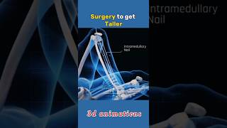 Surgery to get Taller shorts viral trending taller surgery medical [upl. by Tartan299]