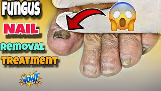 Pedicure ASMR Treatment of Nail fungus removal  Tough Condition  Footcare33 [upl. by Akimik]