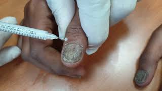 Demo18 Intramatrix injection of triamcinolone for nail disorders [upl. by Lynad]