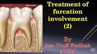 46 Periodontal surgery14 Furcation involvement2Dr Wadhah Periodontology lecturesد وضاح الحاج [upl. by Gunter196]