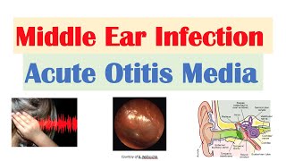 Middle Ear Infection Acute Otitis Media  Causes Symptoms Diagnosis Treatment [upl. by Neva498]