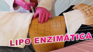 Resultados da Lipo Enzimática  Dr Luciane Bravi Explica [upl. by Notlew]