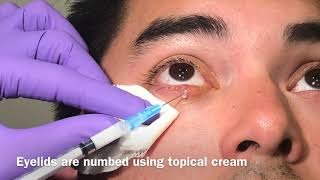 Steroid injection for chalazion [upl. by Nomrej399]