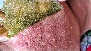 Blackhead Removal Using Mask in AsiaBlackheads Removal [upl. by Akkimat908]