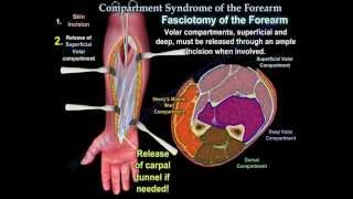 Compartment Syndrome Of The Forearm  Everything You Need To Know  Dr Nabil Ebraheim [upl. by Akla584]